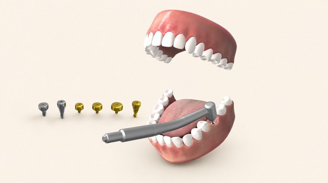 Zion Ics · Dental Implant Patient Education
