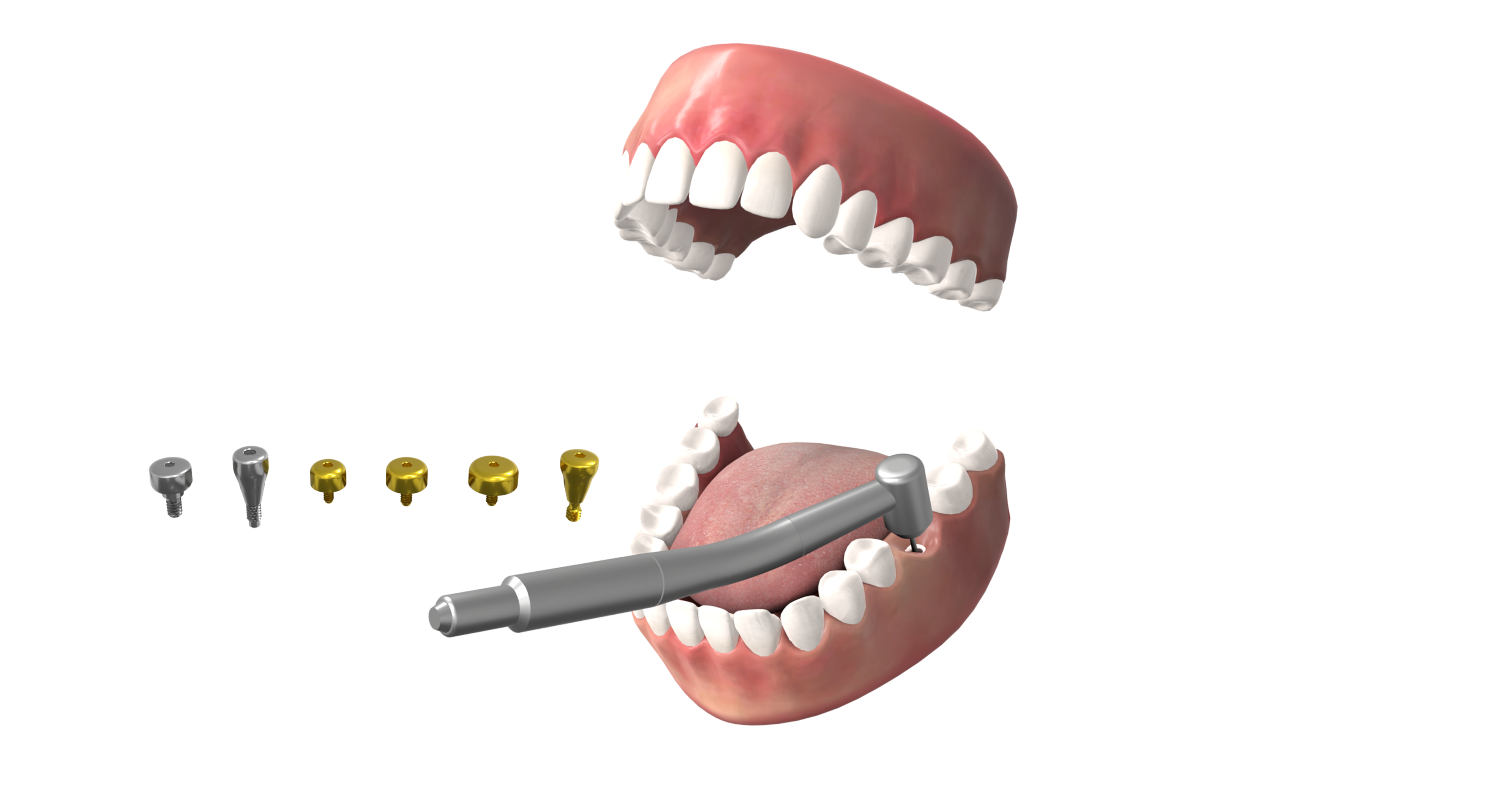 Zion patient-education scene: open mouth, dental drill, implant components